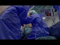 Epilepsie : opération à la fibre laser inédite en Europe