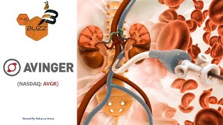 AVINGER INC. “The Buzz&#39;&#39; Show: Avinger, Inc. (NASDAQ: AVGR) Receives FDA Clearance of the Pantheris System