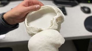 3 D SYS CORP. DL-.001 Austria, osso del cranio sostituito con una protesi 3D: è la prima volta in Europa