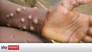 UK Monkeypox cases double to 20