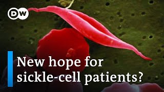 Could gene therapy be a gamechanger in the fight against sickle-cell anemia? | DW News