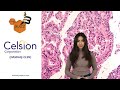 CELSION CORP. - “The Buzz” Show: Celsion Corporation (NASDAQ: CLSN) Receives FDA Fast Track Designation for GEN-1