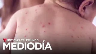 Se multiplican los casos de sarampión, que estaba erradicado en el país | Noticias Telemundo