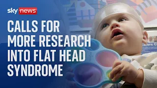 Calls for more research into flat head syndrome in babies and whether helmet therapy works